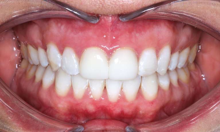 medium_after-teeth-whitening medium_after-teeth-whitening