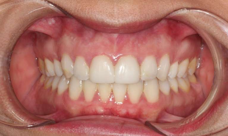 medium_before-teeth-whitening medium_before-teeth-whitening