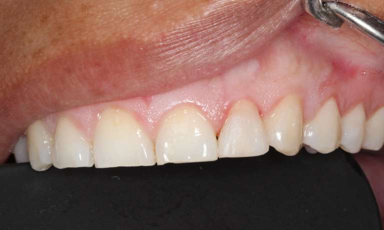 medium_after-decayed-tooth-restored-with-composite-resin medium_after-decayed-tooth-restored-with-composite-resin