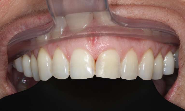 medium_after-discoloured-filling-restored medium_after-discoloured-filling-restored
