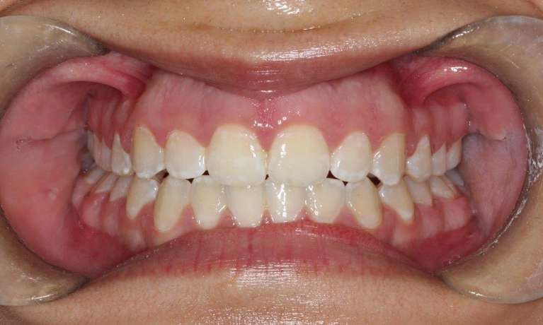 medium_after-expansion-and-braces medium_after-expansion-and-braces
