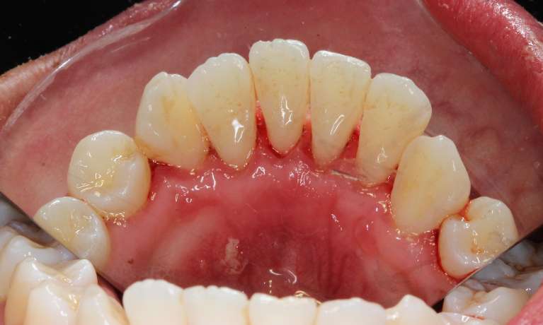 medium_after-professional-dental-clean medium_after-professional-dental-clean