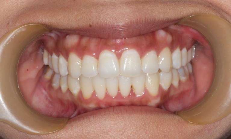 medium_after-straight-teeth-with-damon-braces medium_after-straight-teeth-with-damon-braces