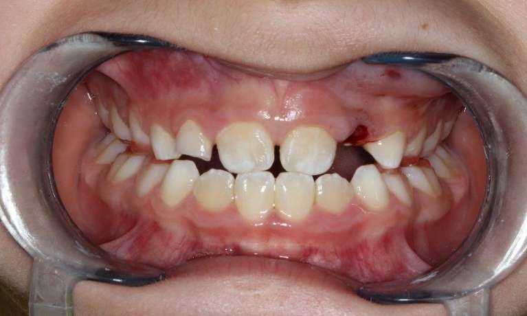 medium_after-teeth-correction-with-myobrace medium_after-teeth-correction-with-myobrace
