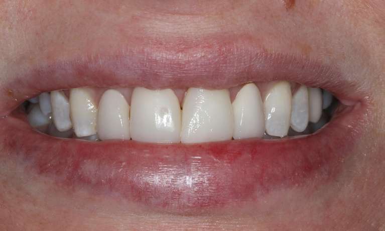 medium_after-veneer-repair-with-composite medium_after-veneer-repair-with-composite