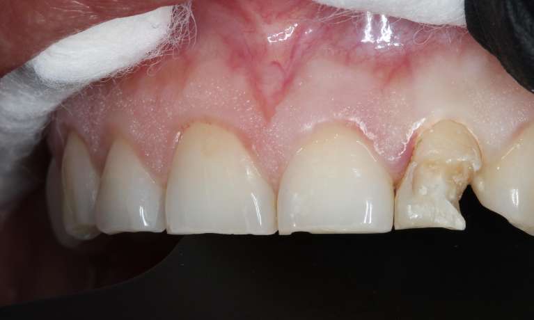 medium_before-decayed-tooth-restored-with-composite-resin medium_before-decayed-tooth-restored-with-composite-resin