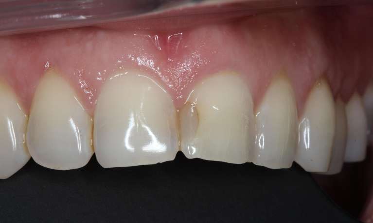medium_before-discoloured-filling-restored medium_before-discoloured-filling-restored