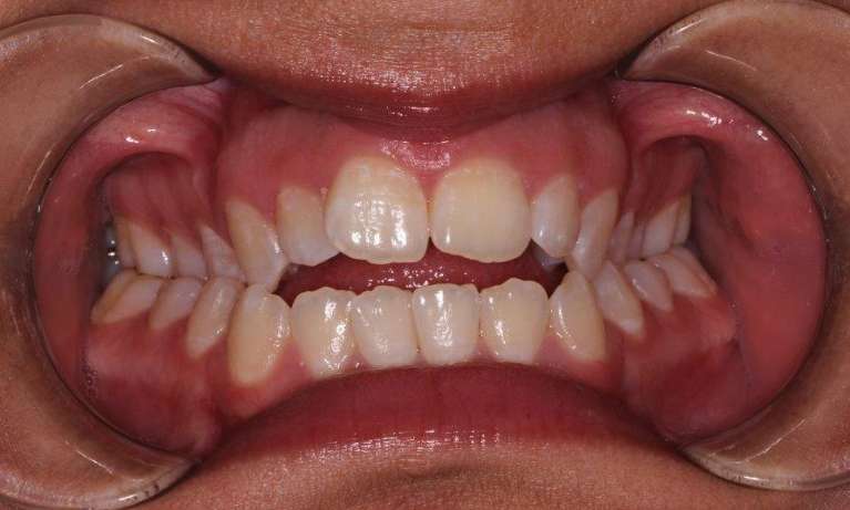 medium_before-expansion-and-braces medium_before-expansion-and-braces