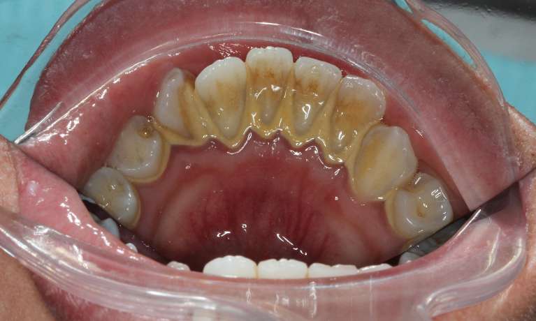 medium_before-professional-dental-clean medium_before-professional-dental-clean