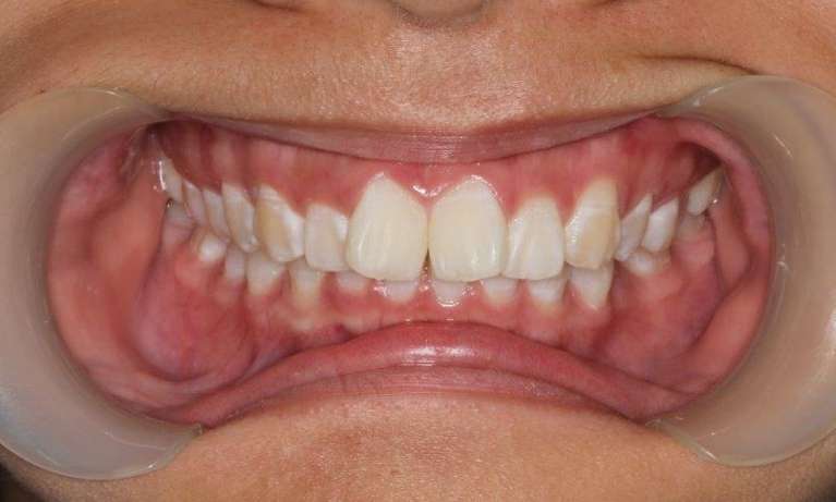 medium_before-straight-teeth-using-damon-braces medium_before-straight-teeth-using-damon-braces