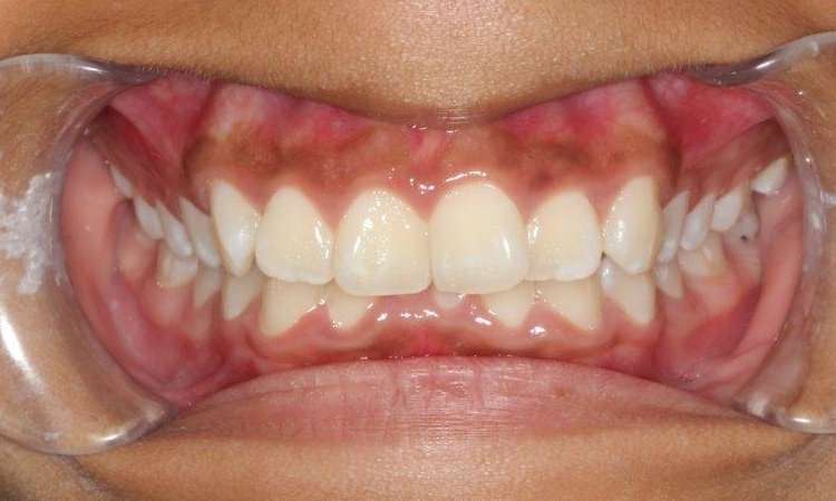 medium_before-straight-teeth-with-braces medium_before-straight-teeth-with-braces
