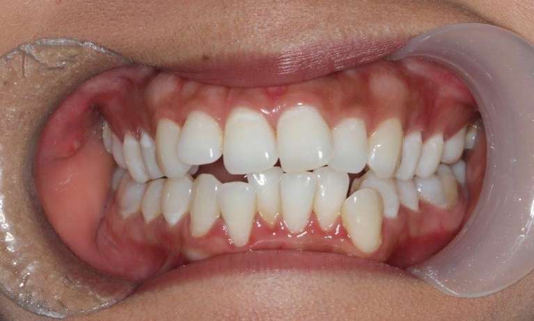 medium_before-straight-teeth-with-damon-braces medium_before-straight-teeth-with-damon-braces