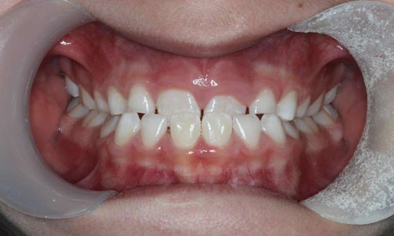 medium_before-teeth-correction-with-myobrace medium_before-teeth-correction-with-myobrace
