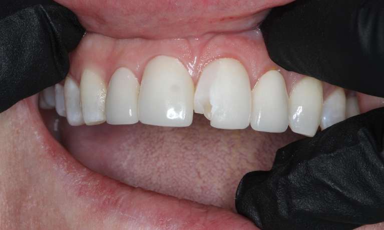 medium_before-veneer-repair-with-composite medium_before-veneer-repair-with-composite